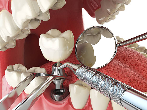 Best Knocked-Out Tooth (Avulsed Tooth) Treatment in Cetronia, PA
